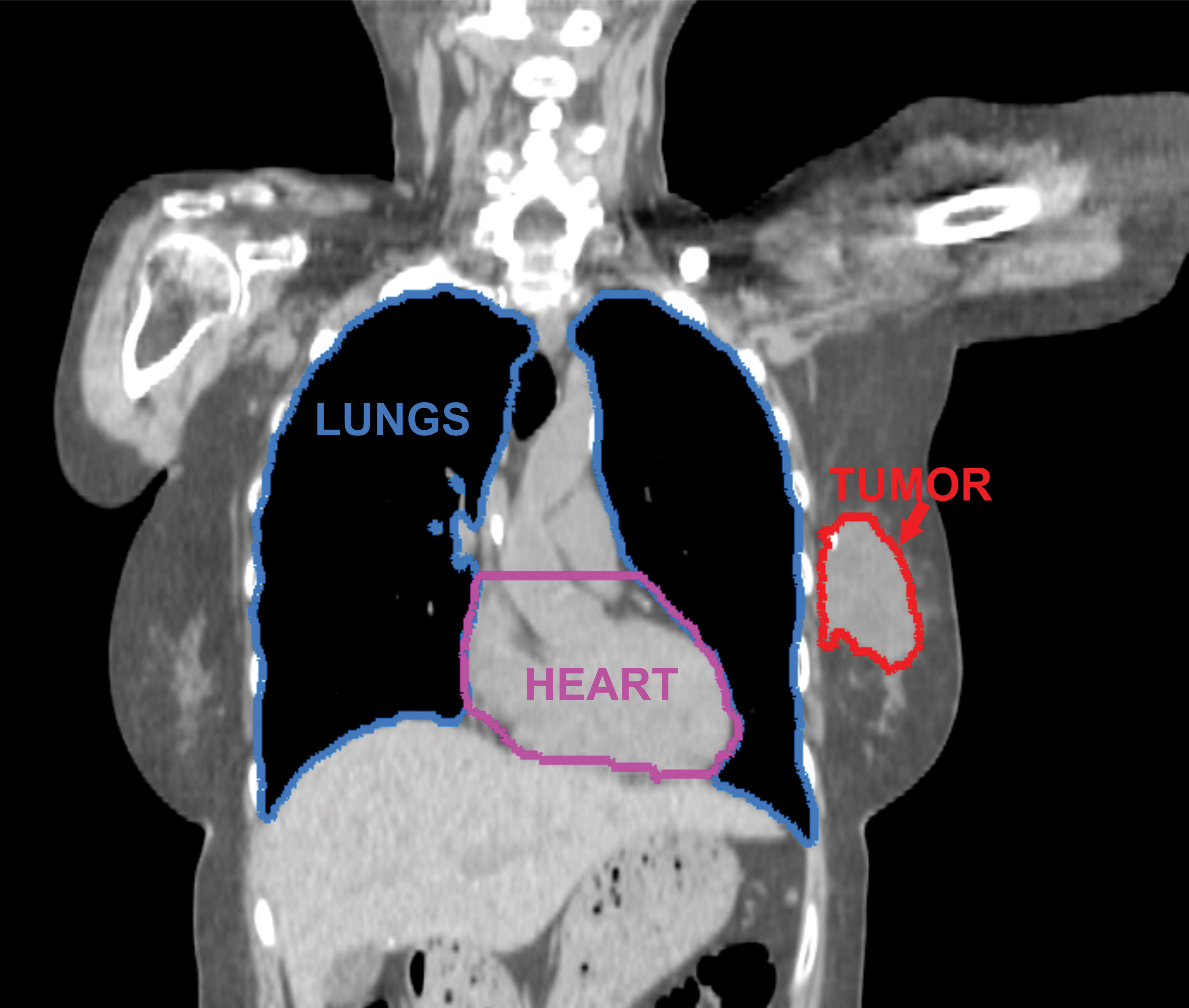 Image of CT scan of a chest tumor